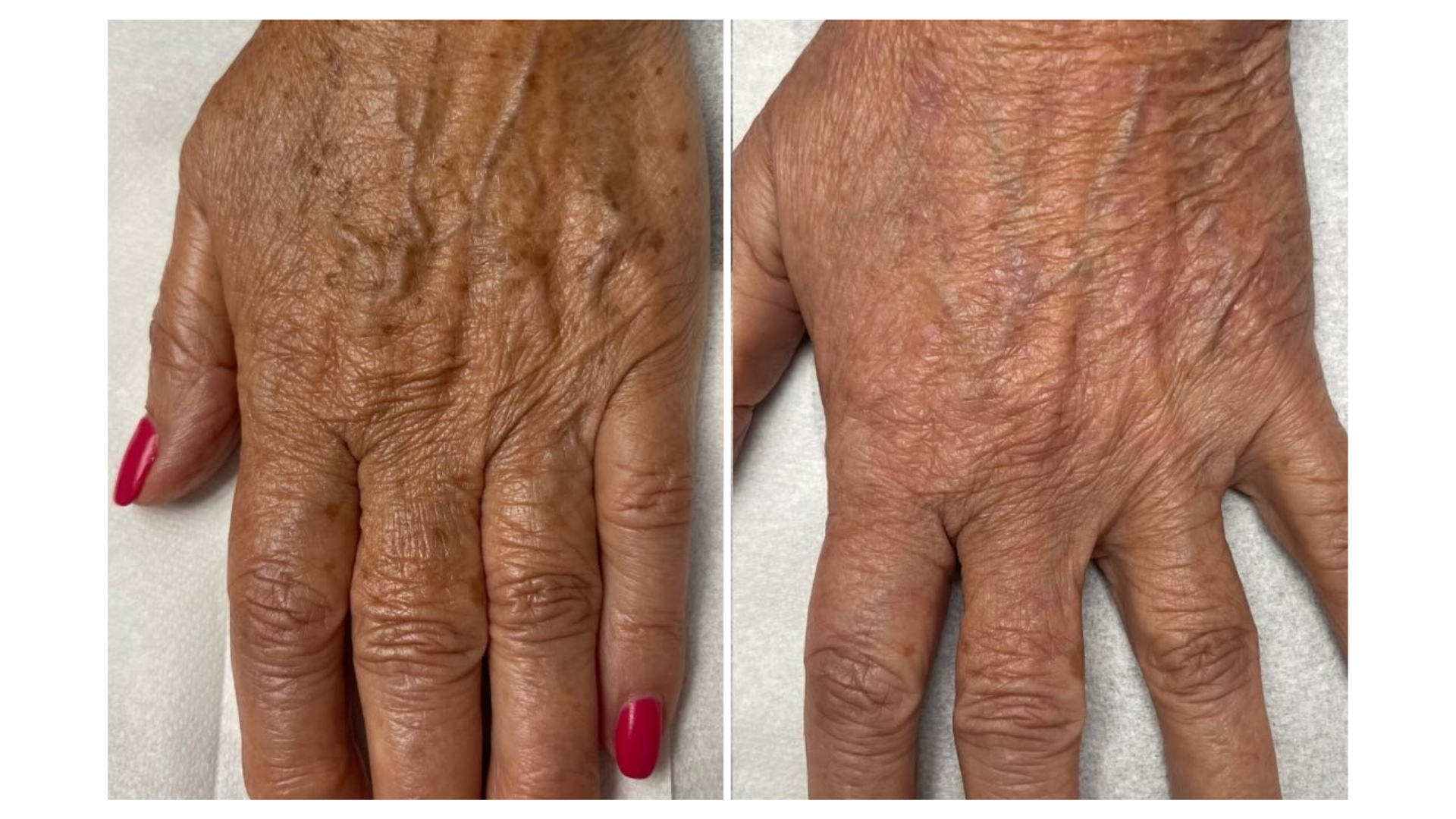 Pigmented Lesions