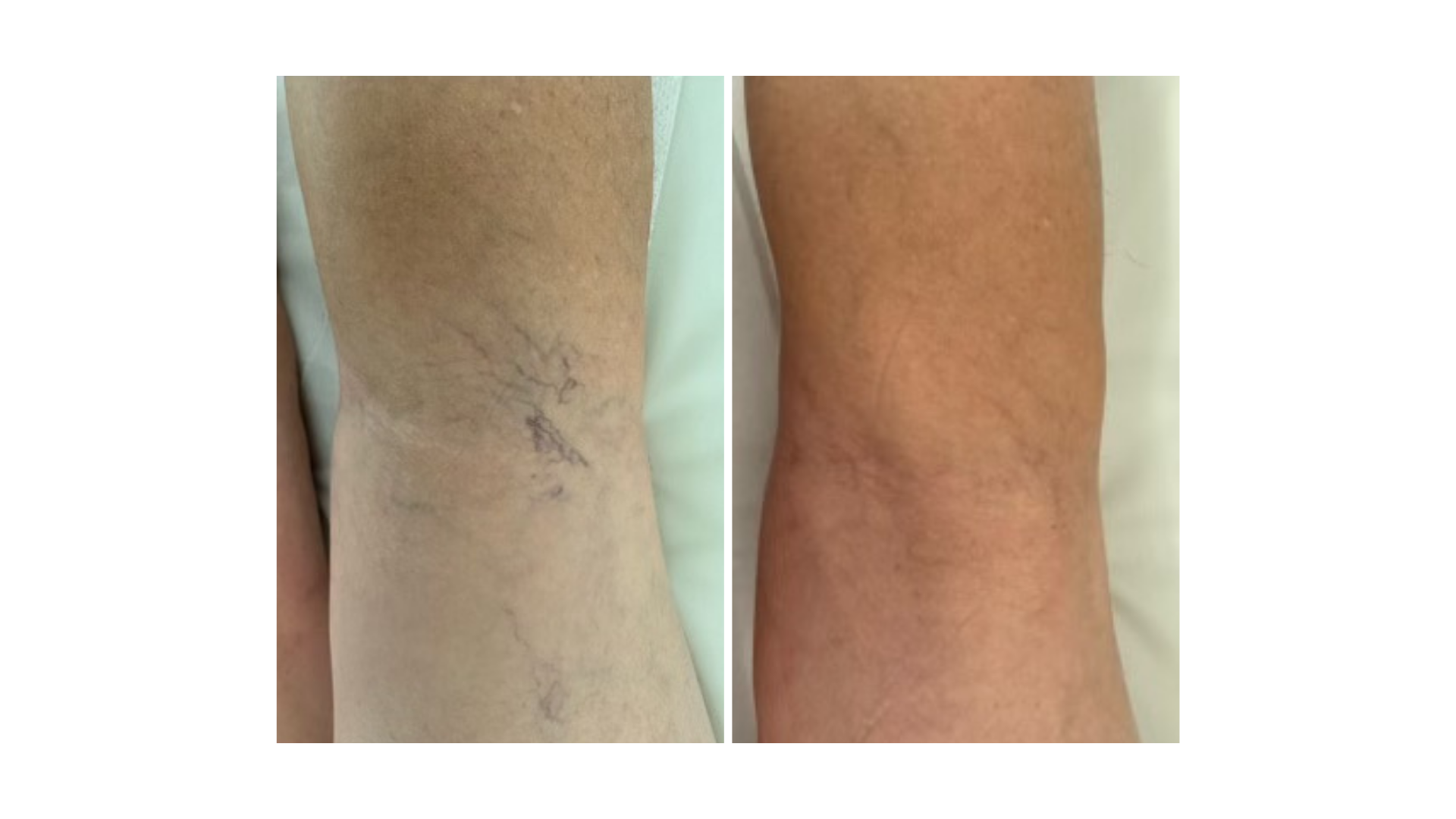 Vascular Lesions