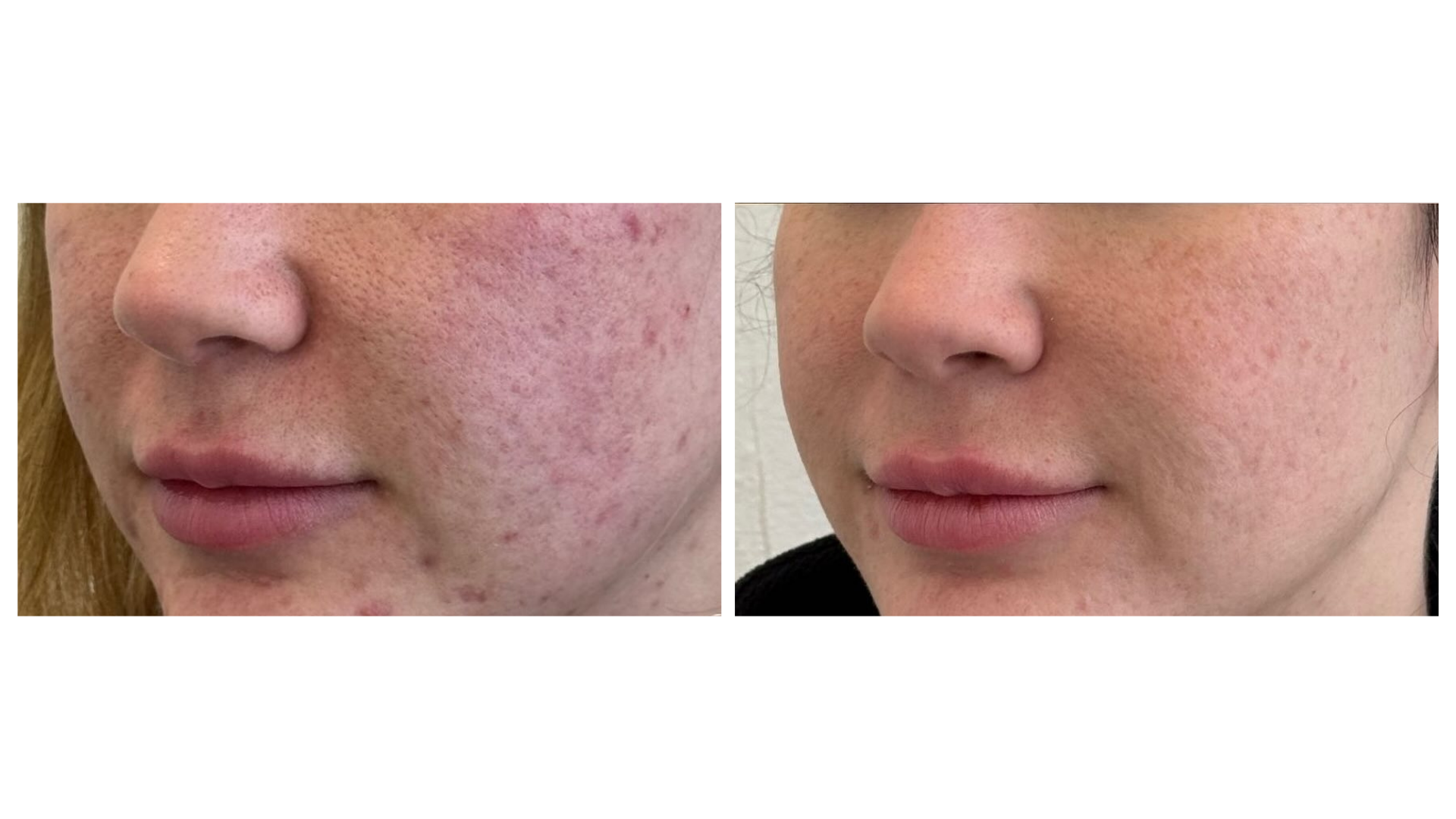 Acne Scar Revision Treatment