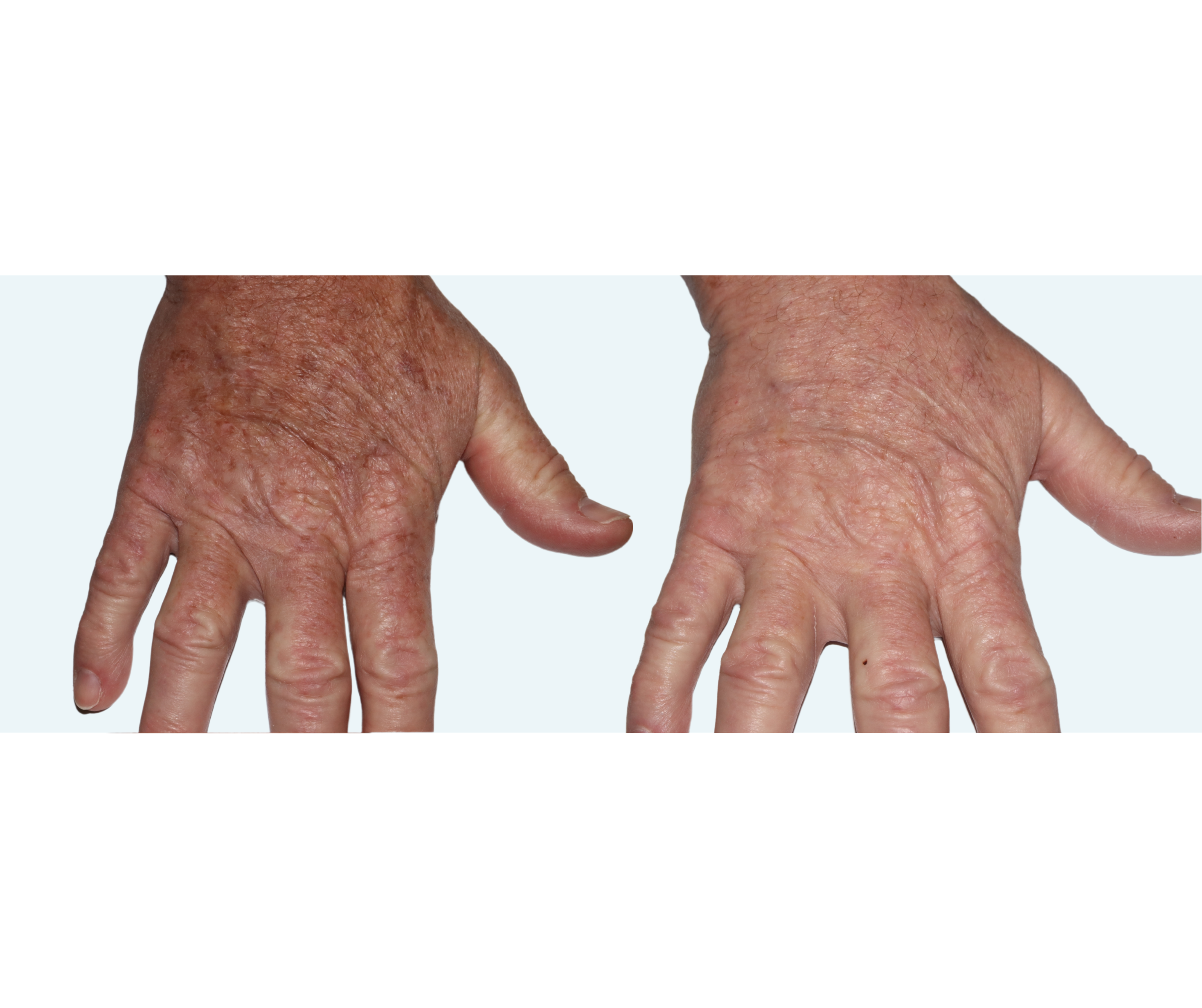 Pigmented Lesions
