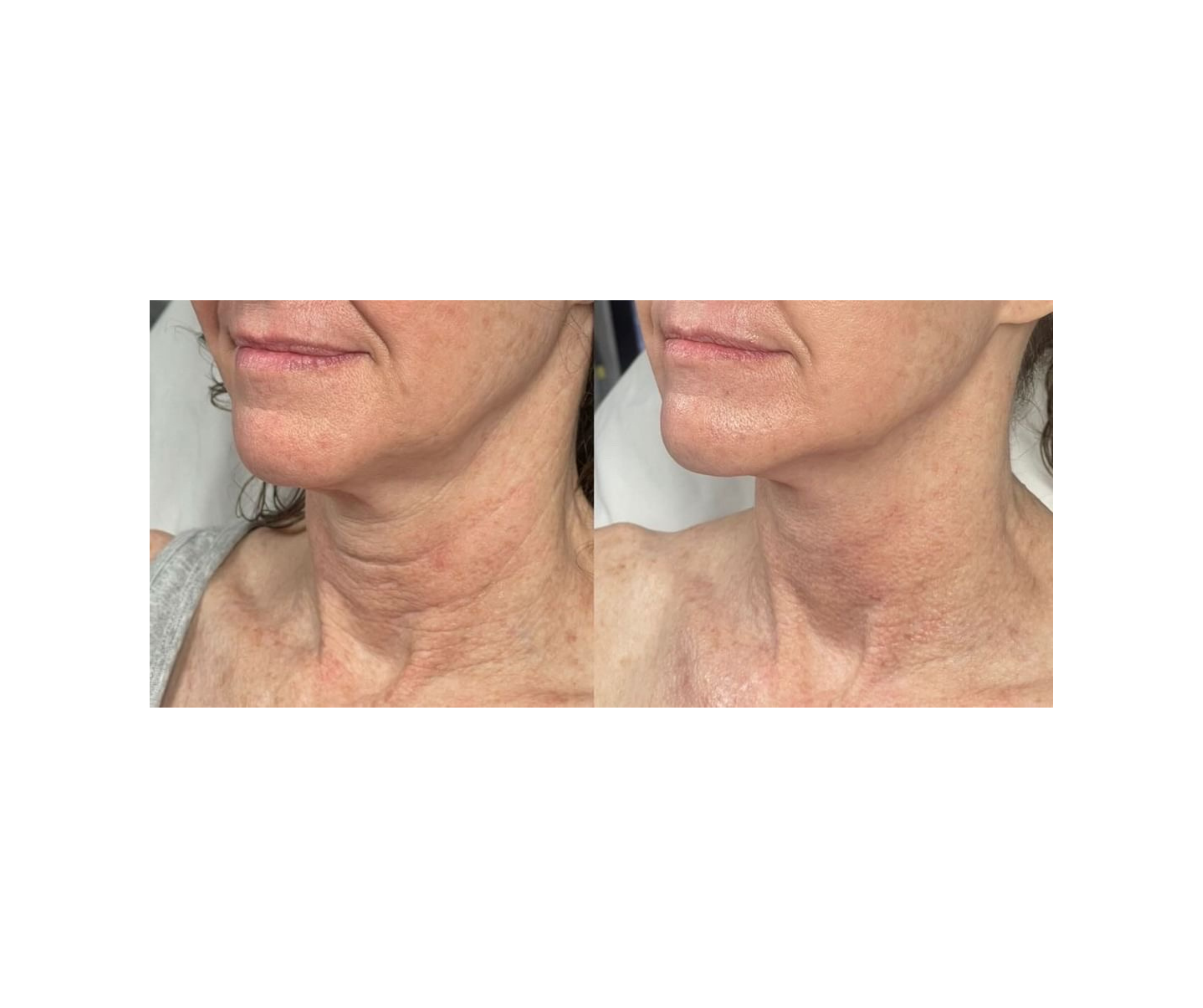 Fotona TightSculpting®