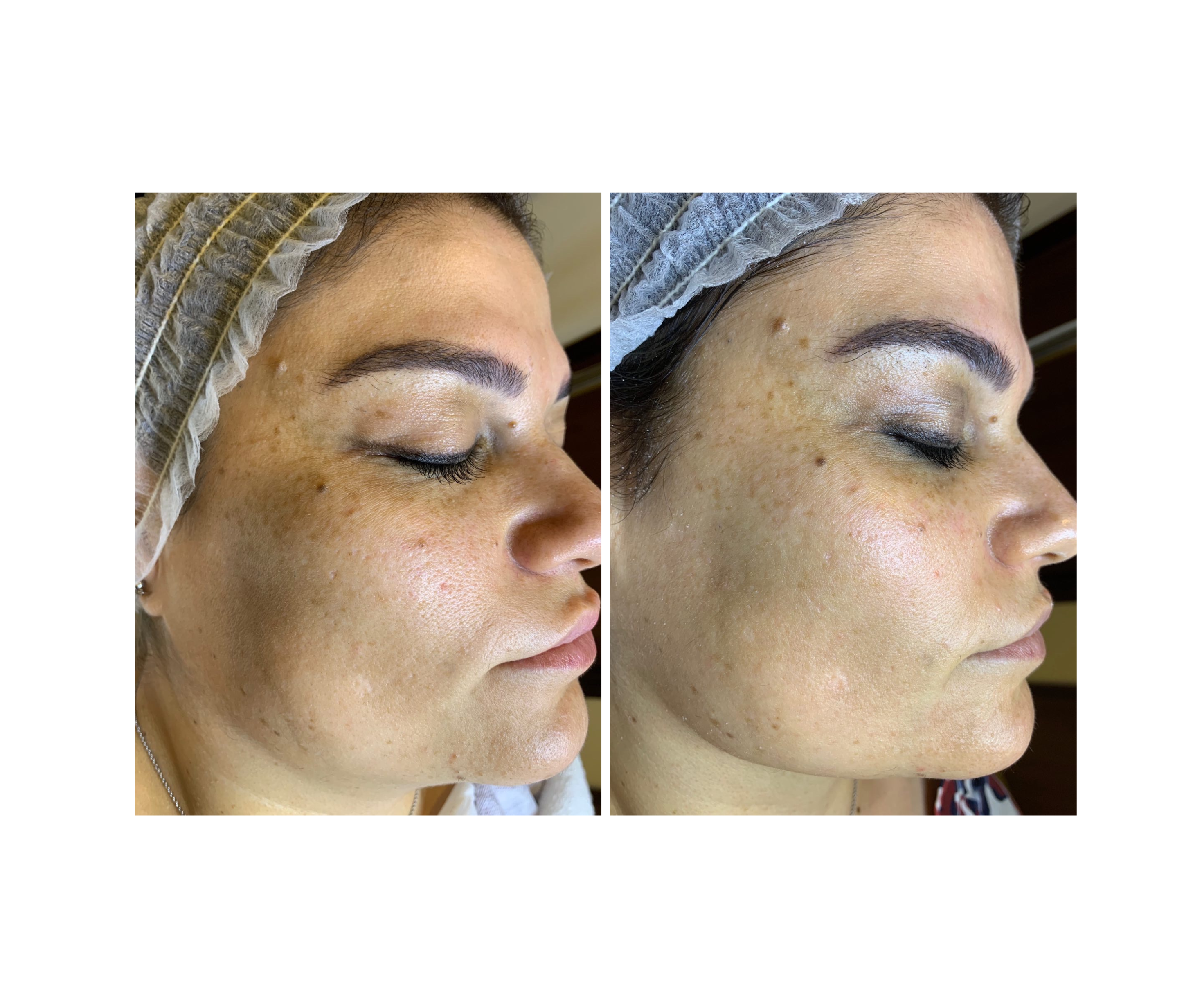 Skin Resurfacing