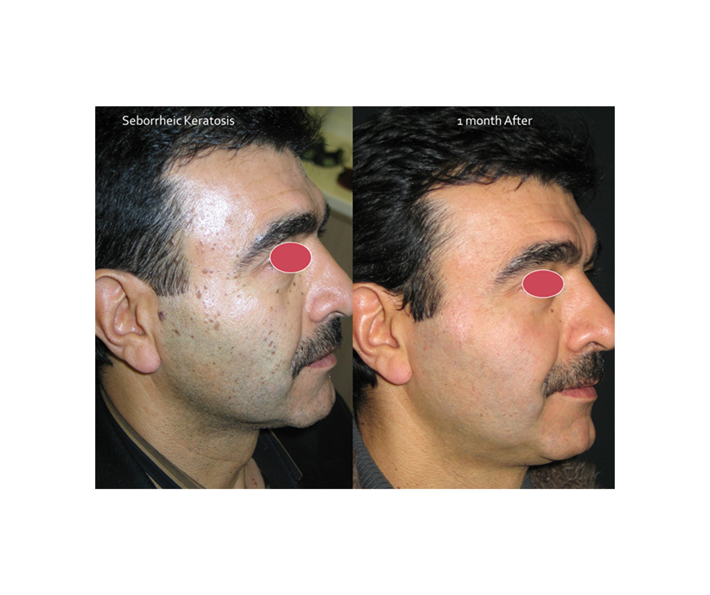 Pigmented Lesions