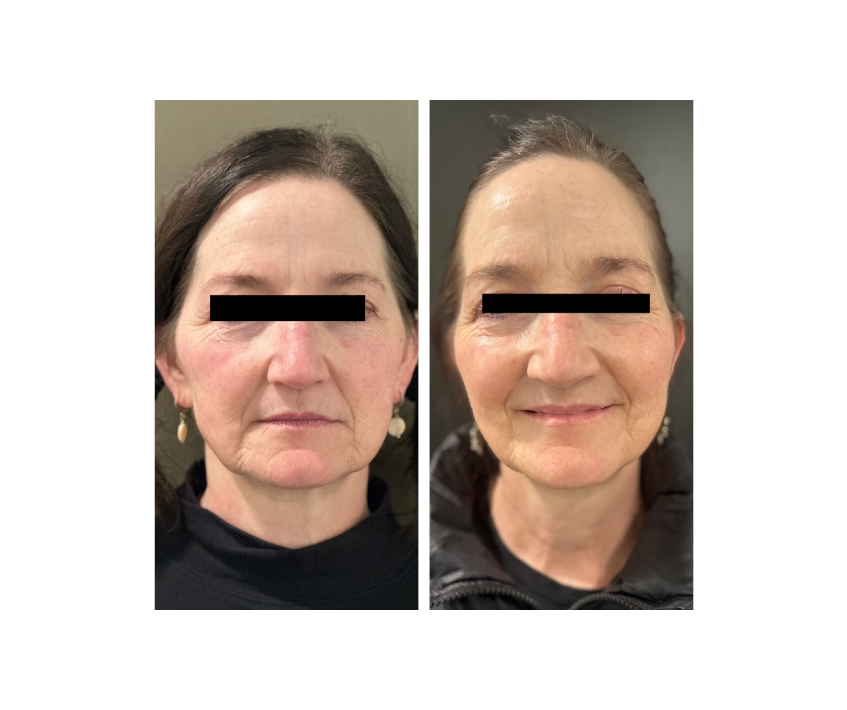 Skin Resurfacing