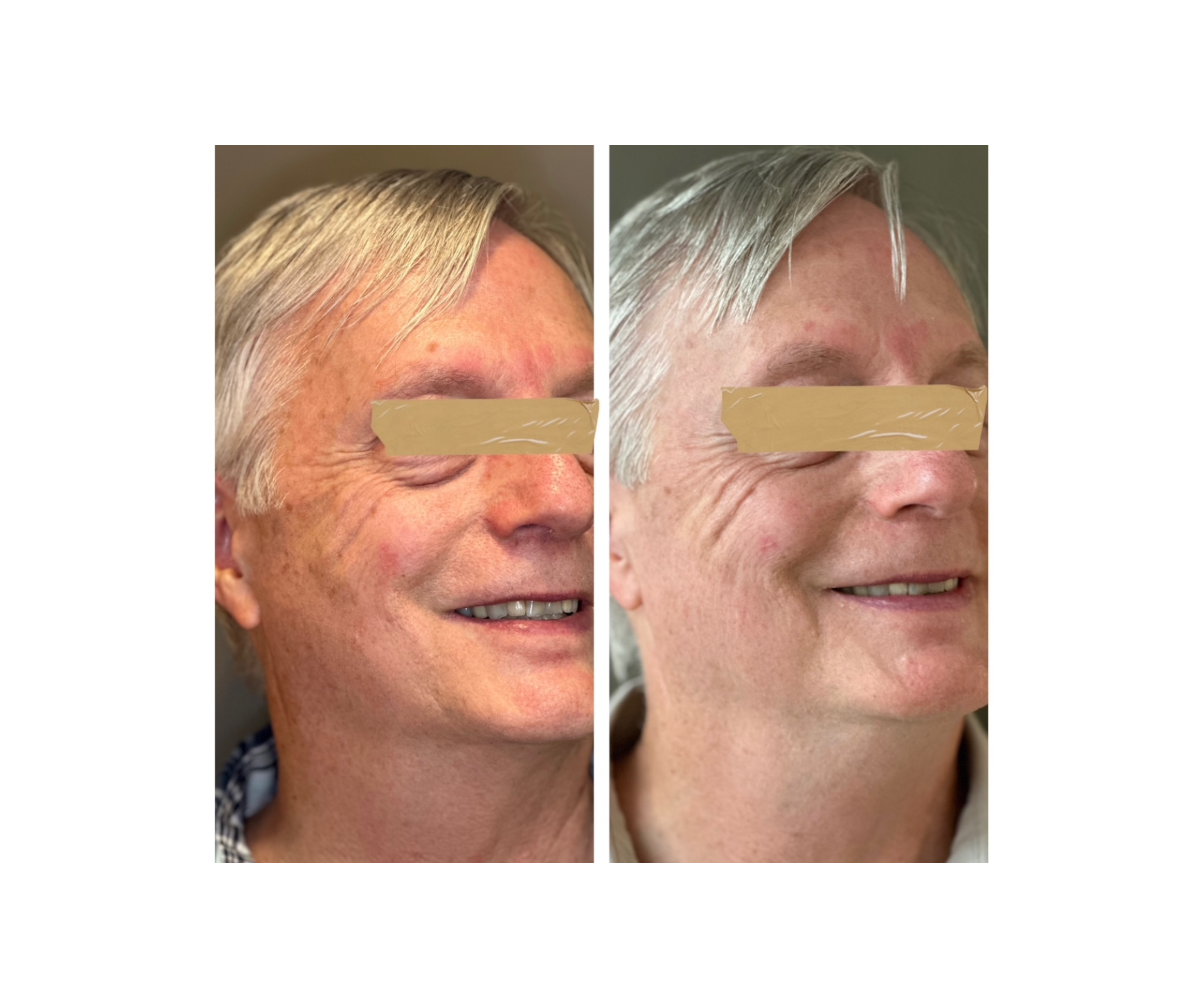 Skin Resurfacing