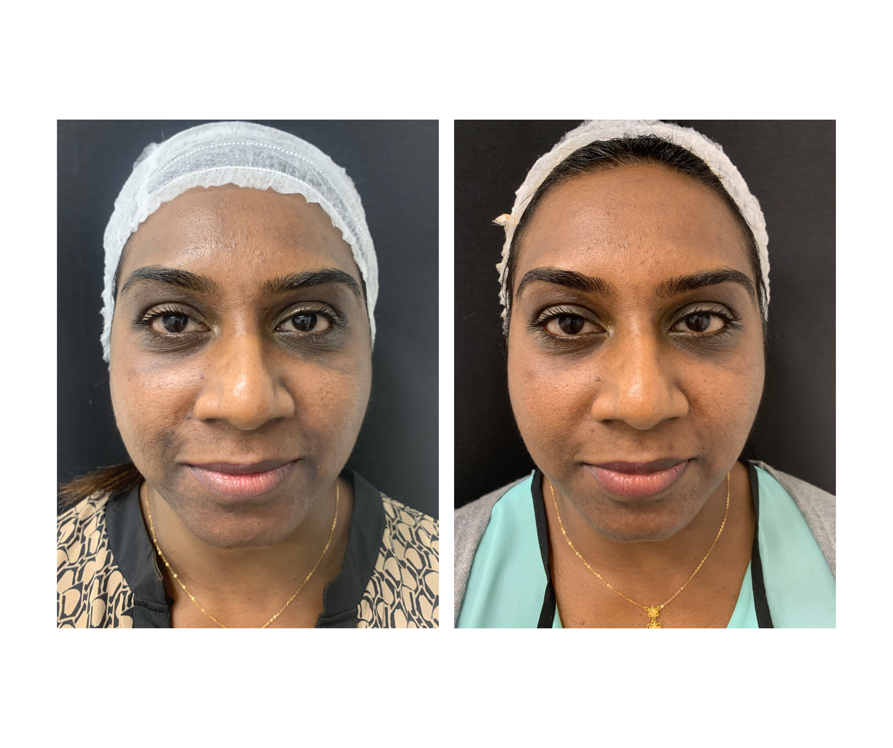Skin Resurfacing