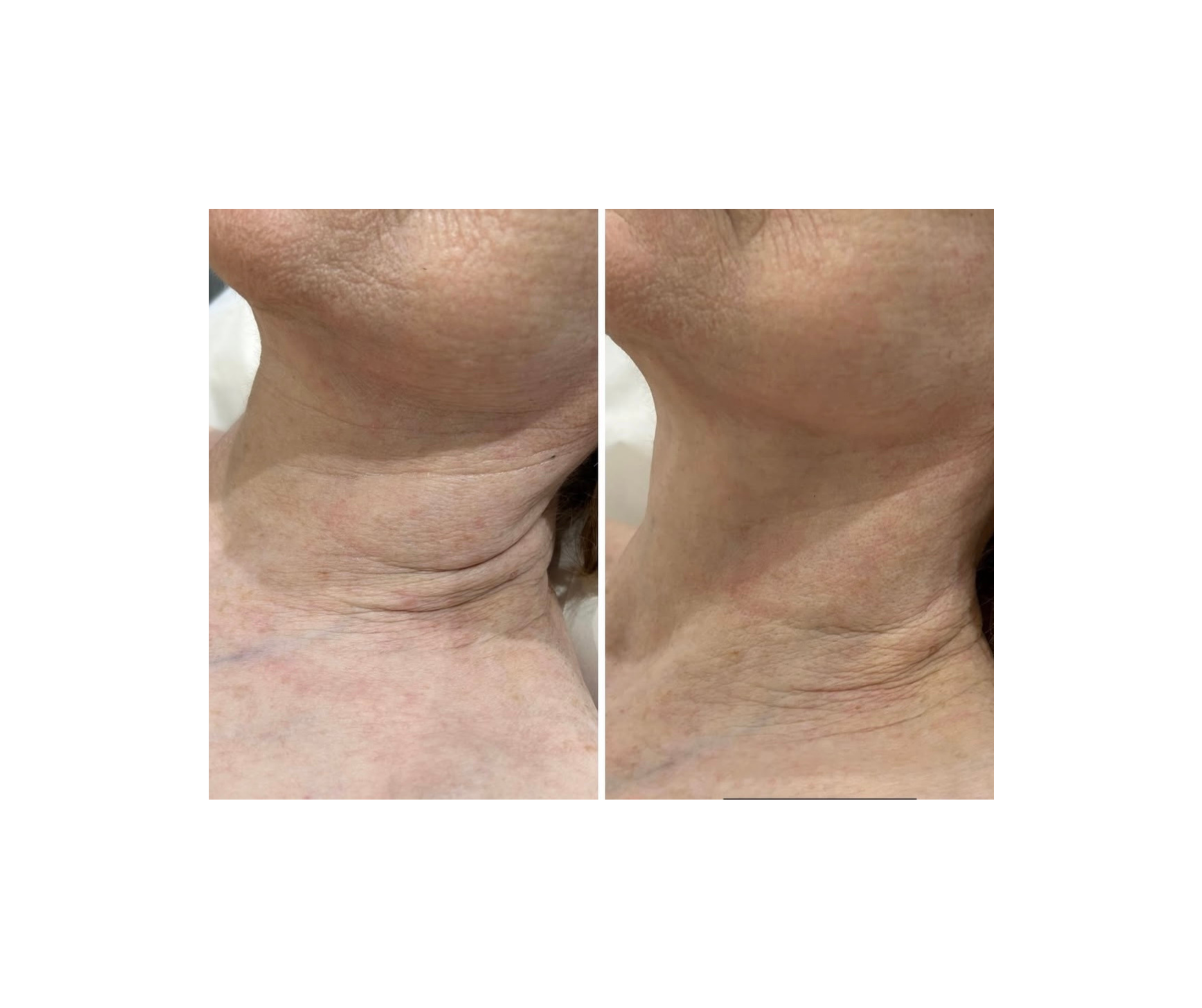 Fotona TightSculpting®