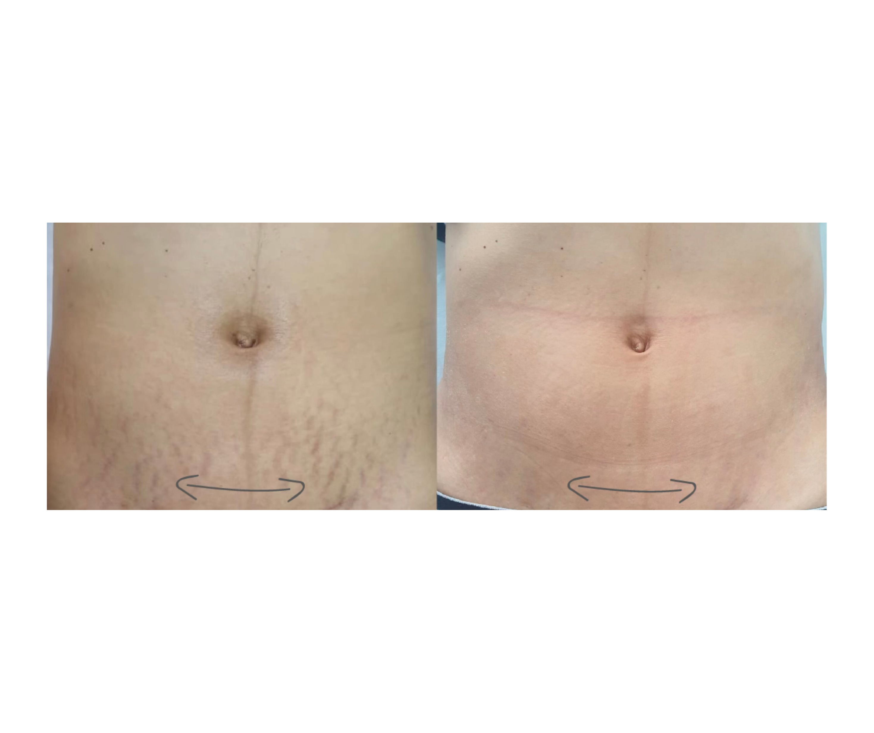 Stretch Mark Revision Treatment