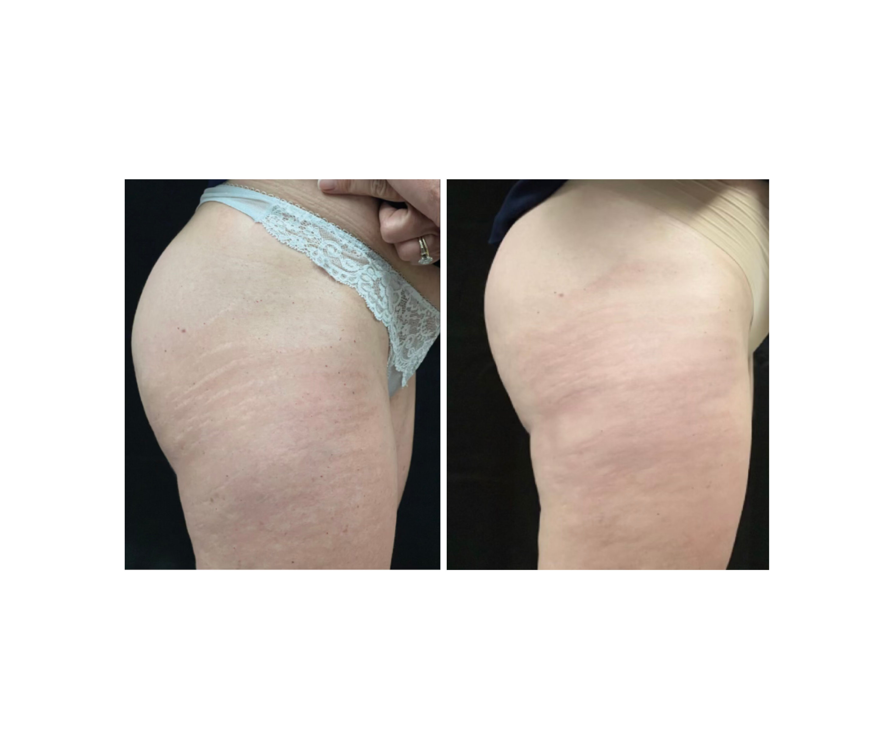 Stretch Mark Revision Treatment