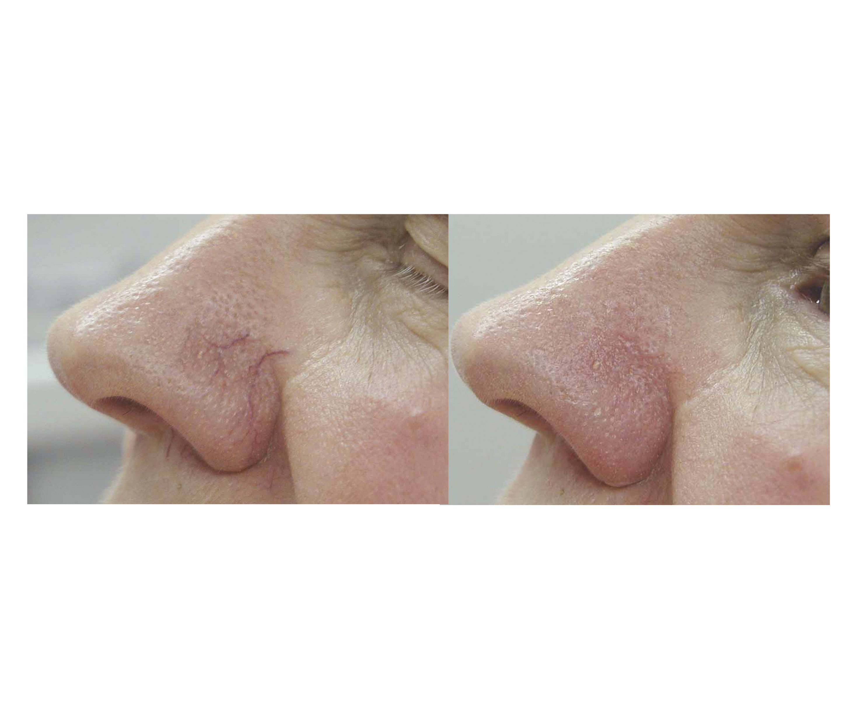 Facial Vascular Lesion Removal