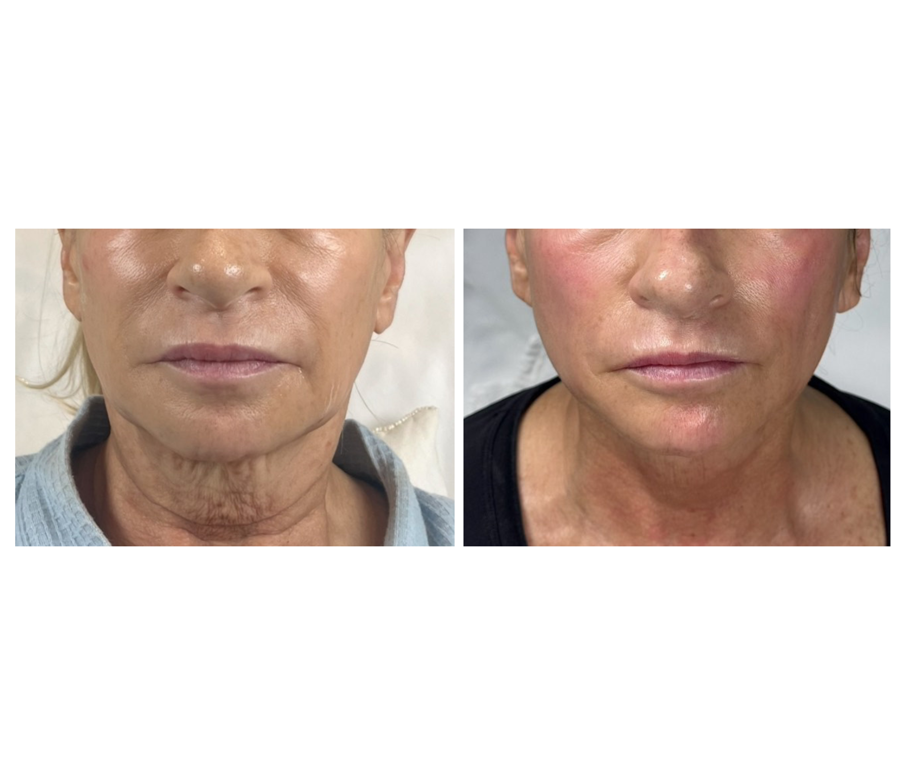 Fotona TightSculpting®