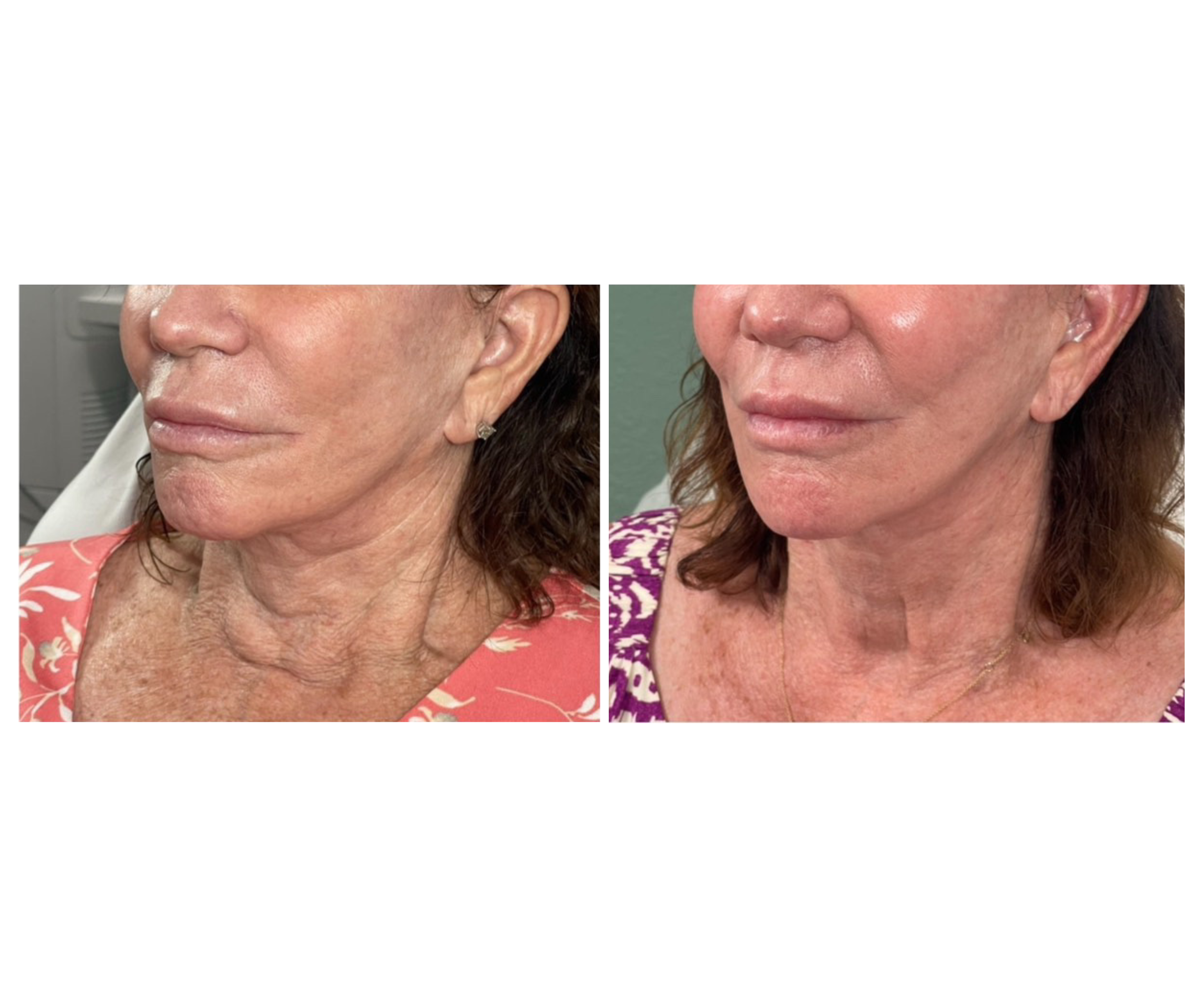 Fotona TightSculpting®