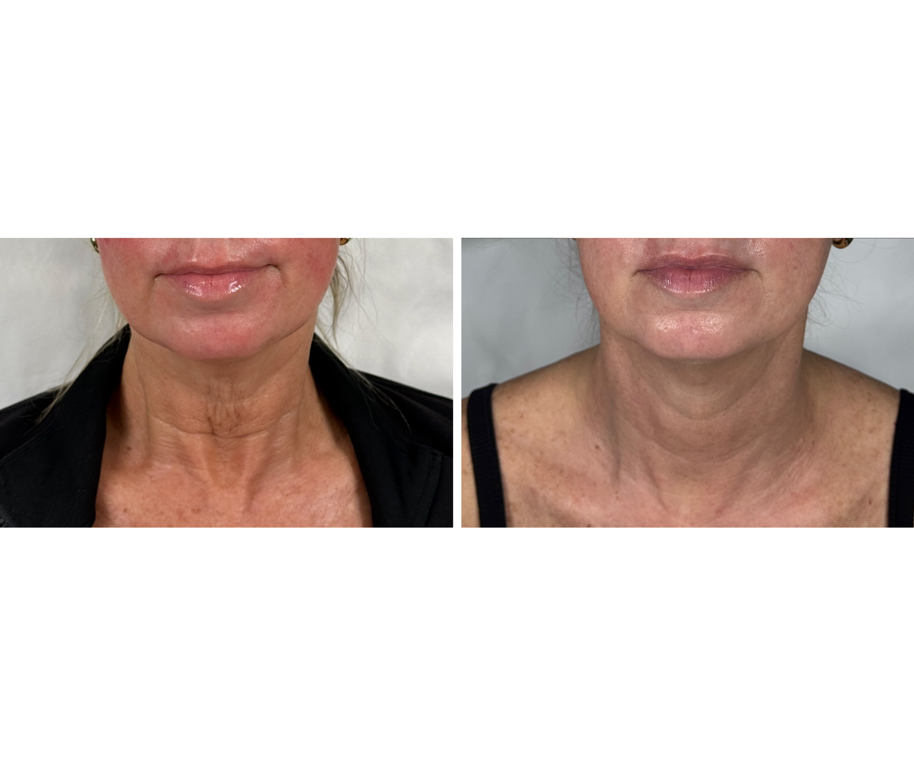 Fotona TightSculpting®