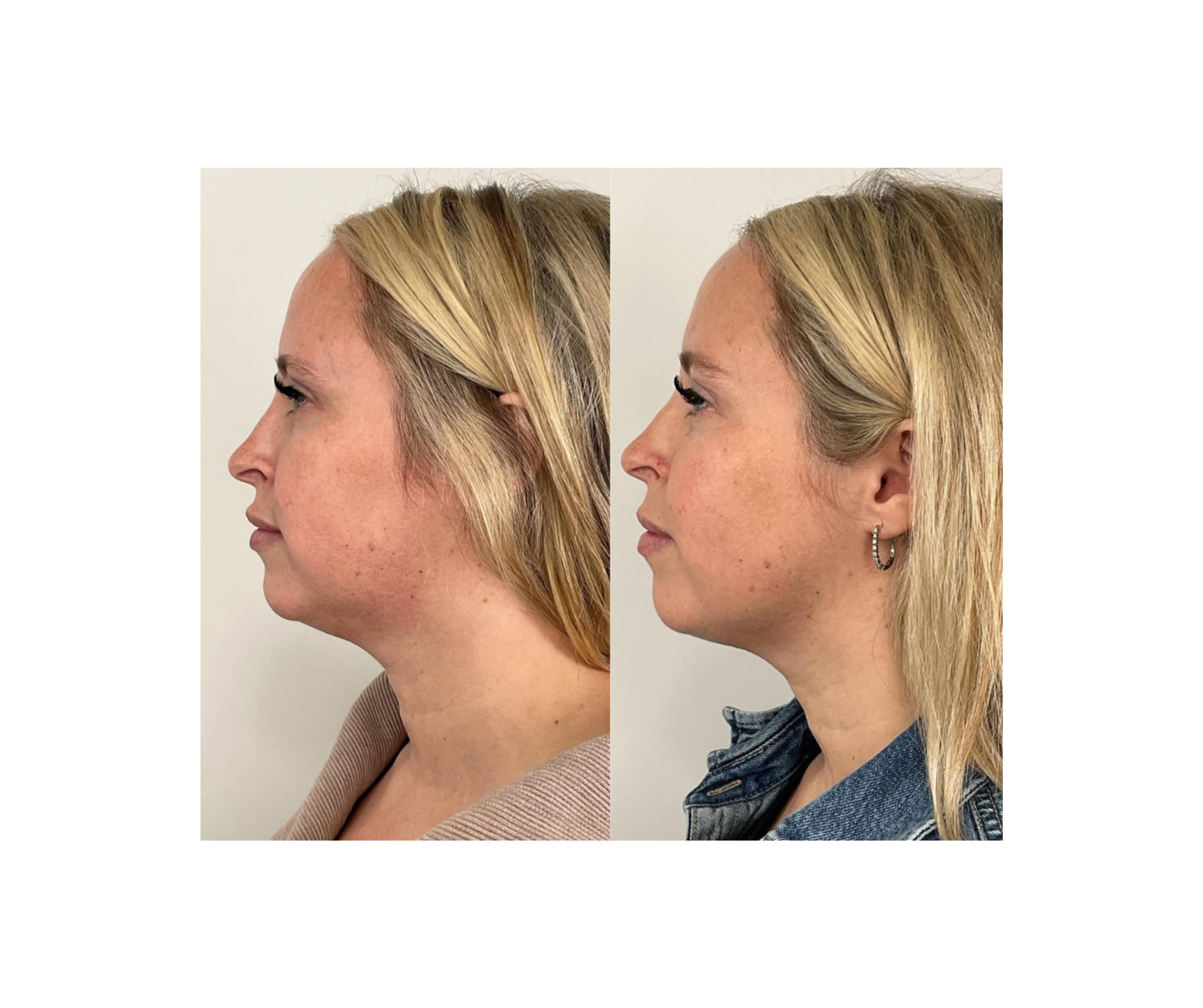 Fotona TightSculpting®
