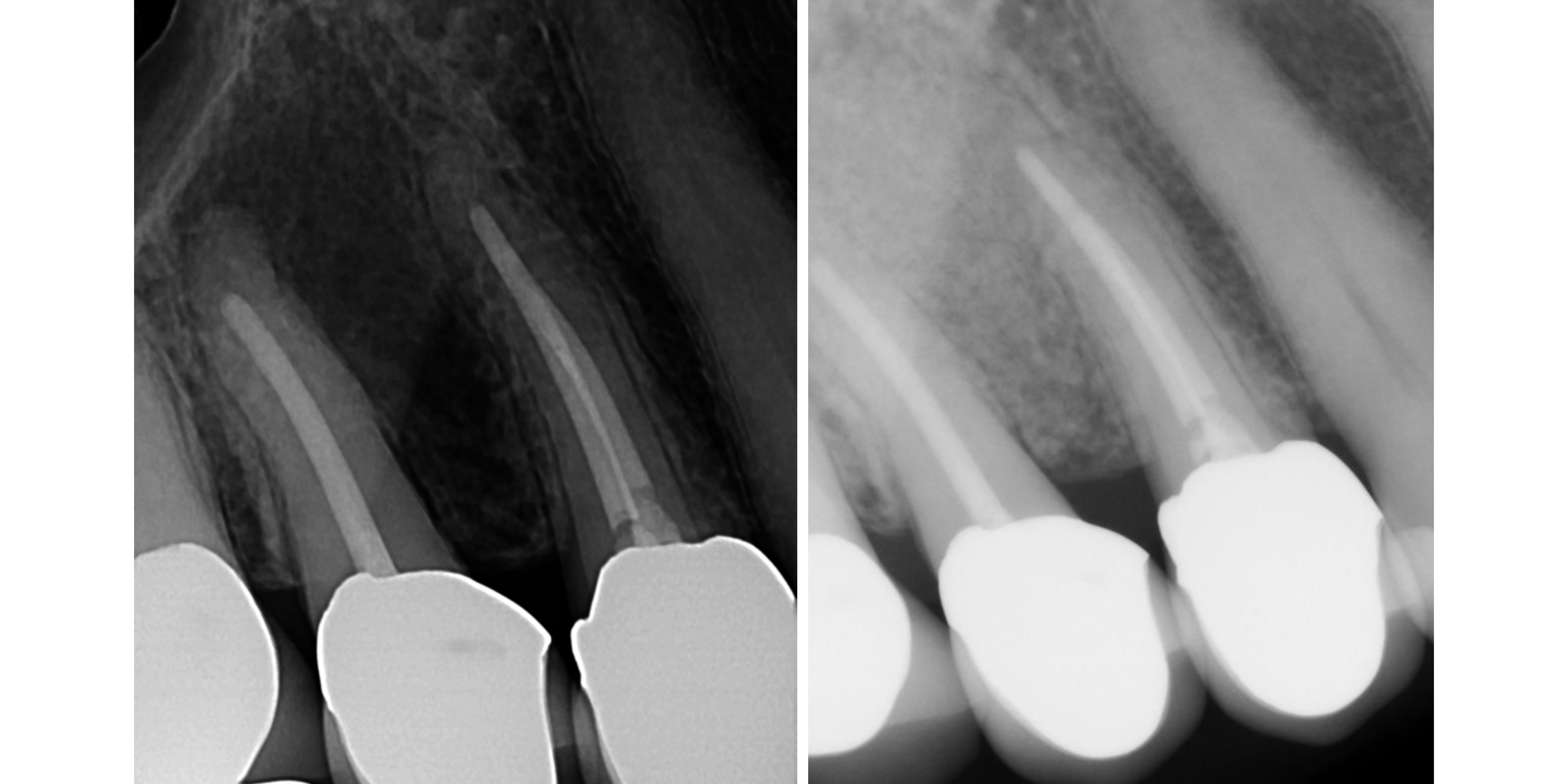 Fotona TwinLight® Periodontal Treatment