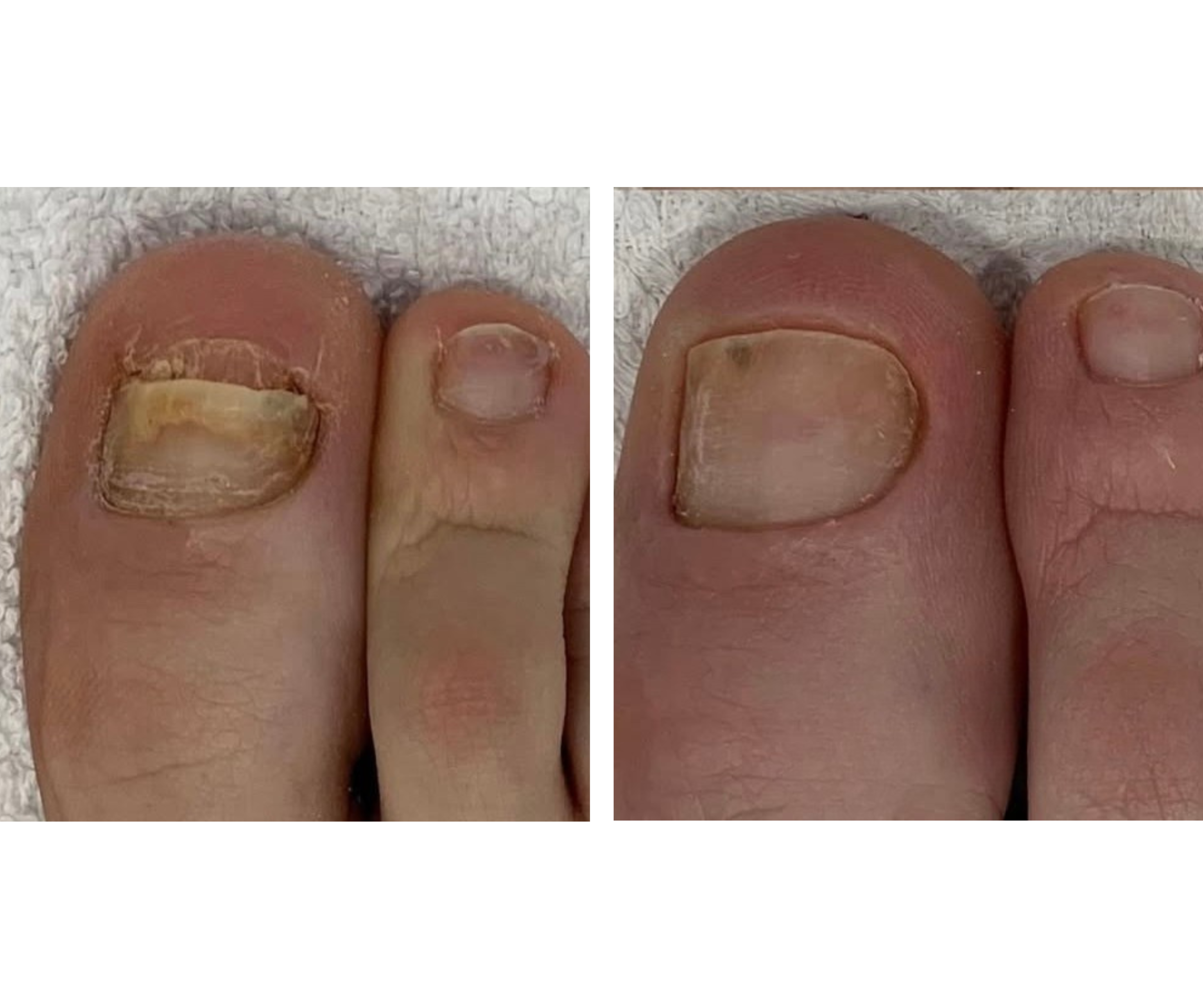 Fotona® ClearSteps