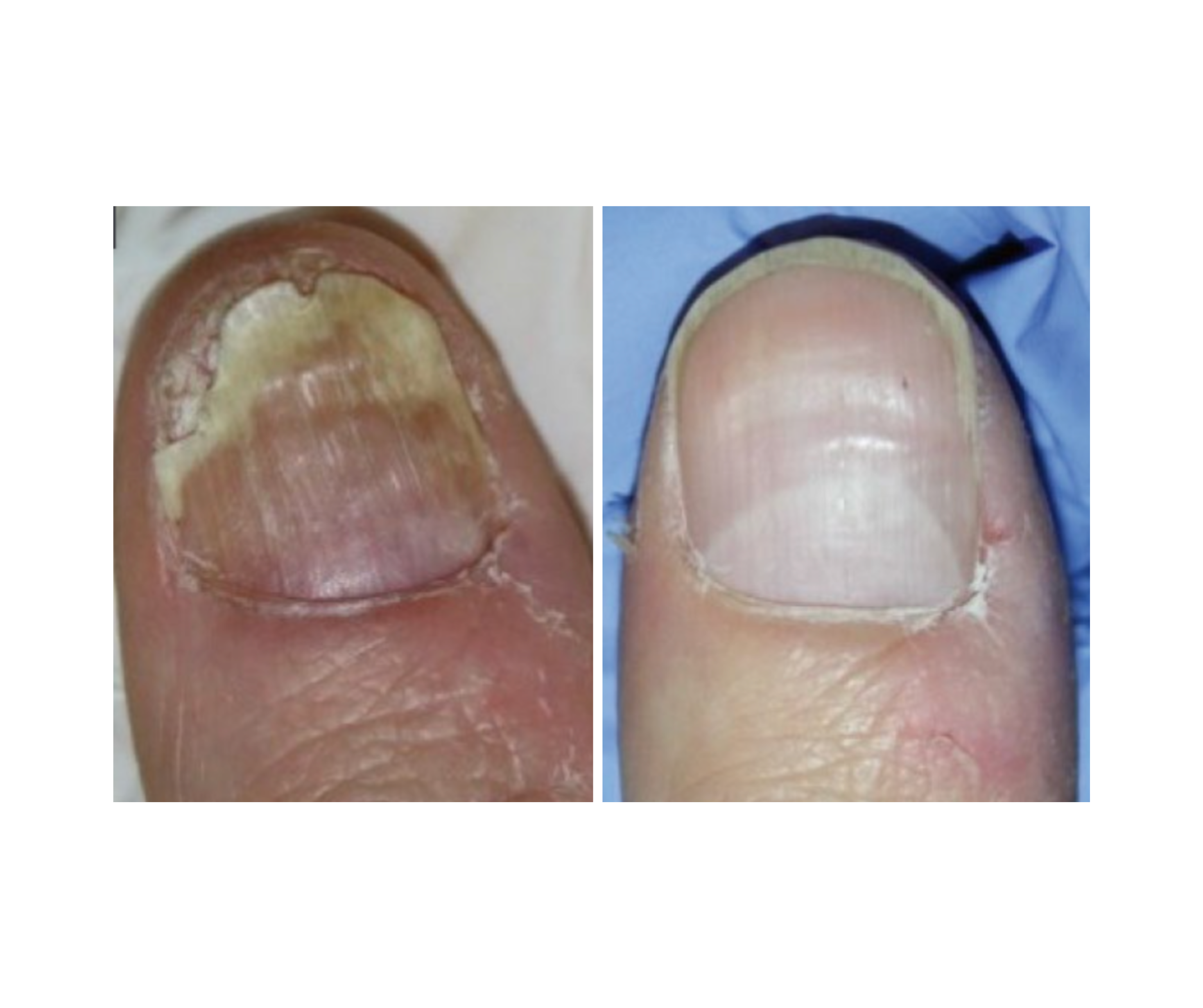 Fotona® ClearSteps