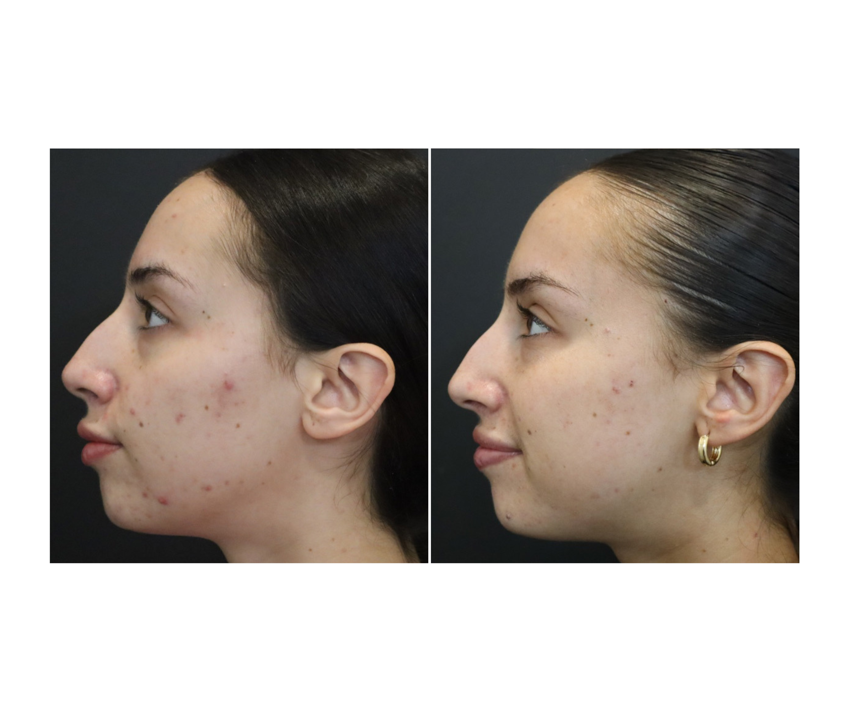 Active Acne Treatment