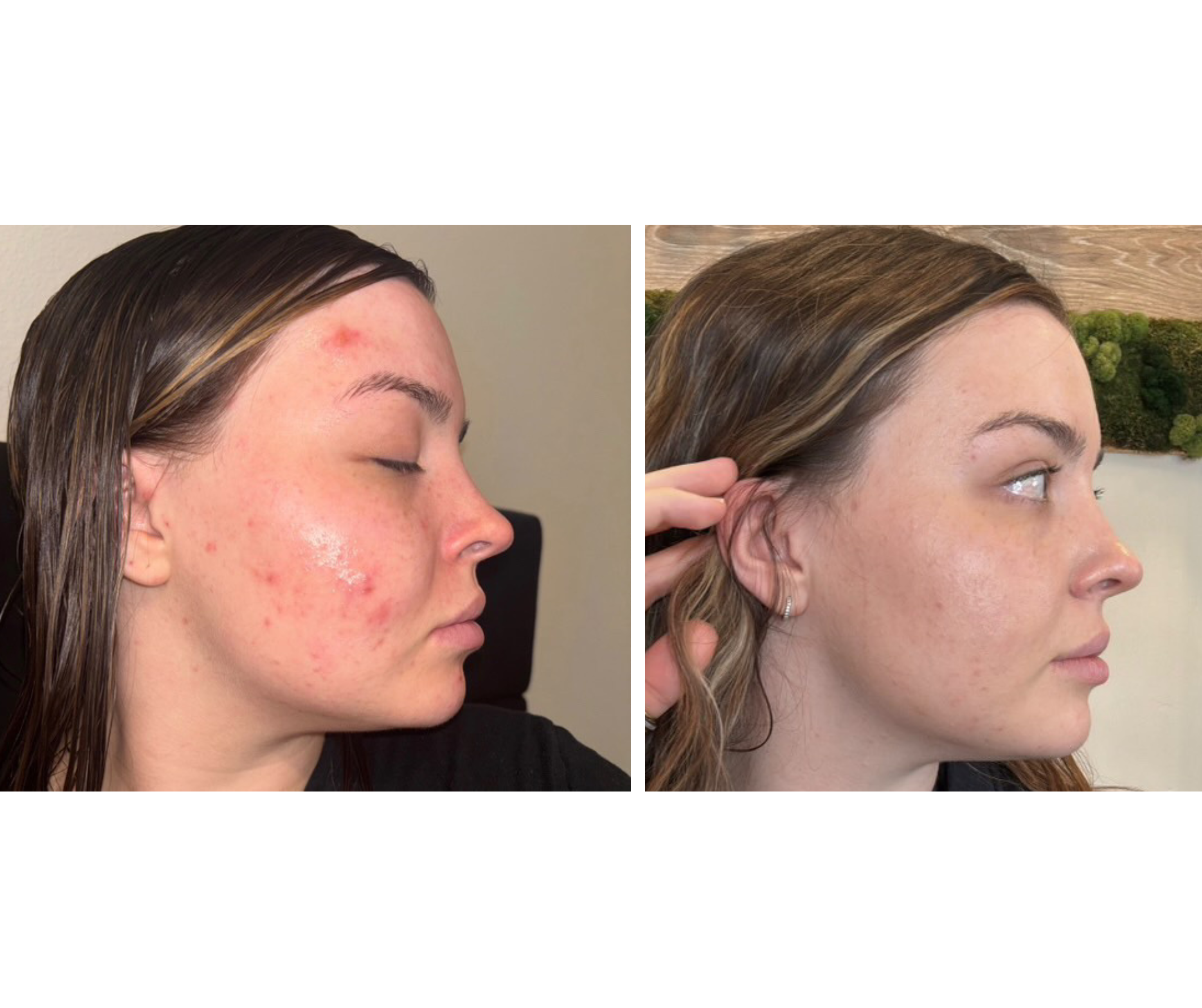 Active Acne Treatment