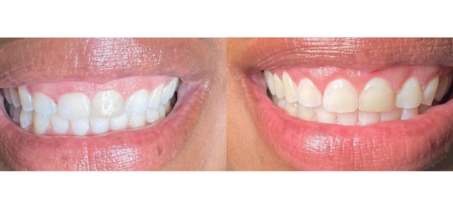 Gingivectomy
