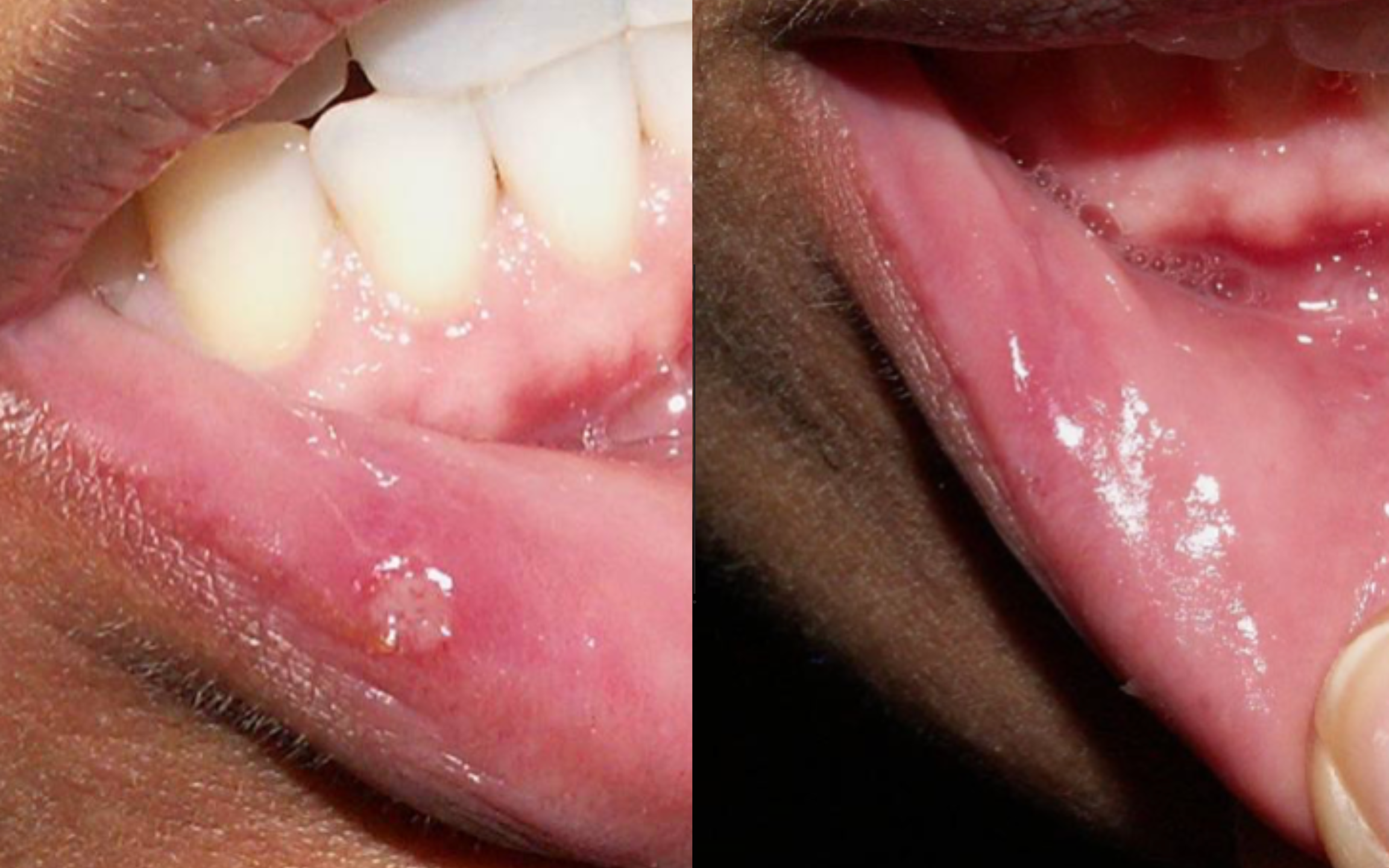 Aphthous Ulcers