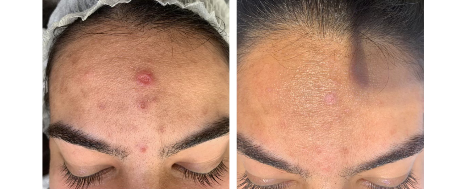 Active Acne Treatment