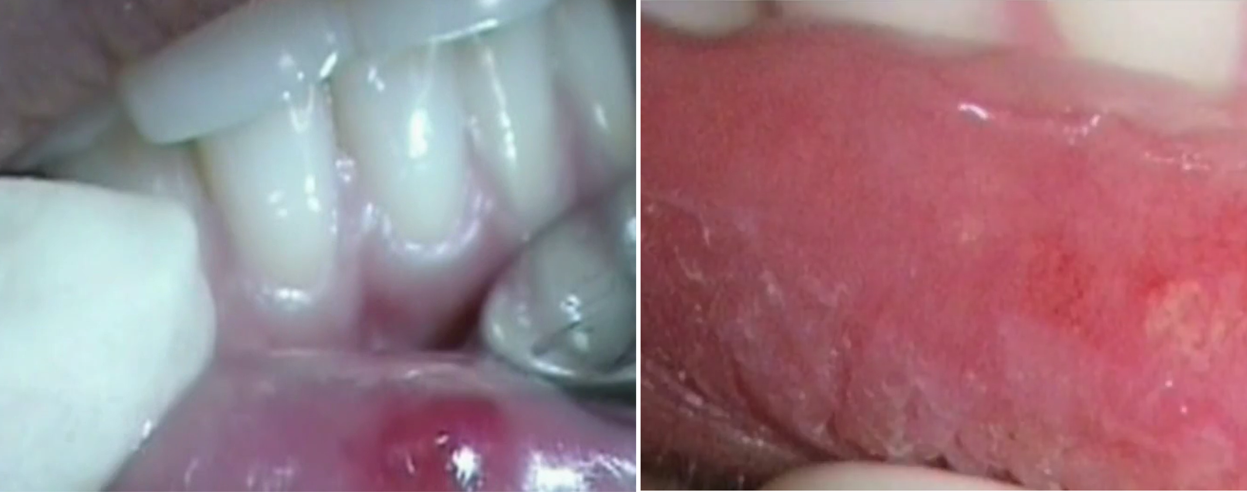 Herpetic Lesion